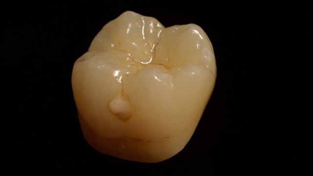 cercon-xt-molar